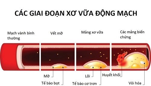 Biến chứng nguy hiểm khi mỡ máu tiến triển nặng