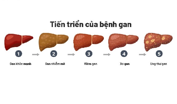 Những biểu hiện nhẹ ban đầu của nóng gan - mệt mỏi, khó chịu vùng gan