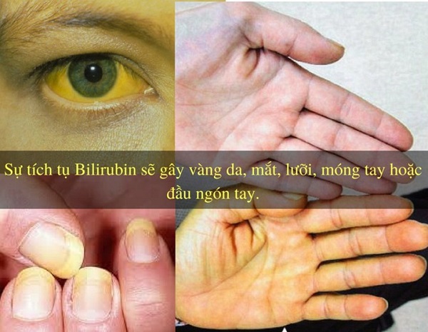 Dấu hiệu nhận biết viêm gan