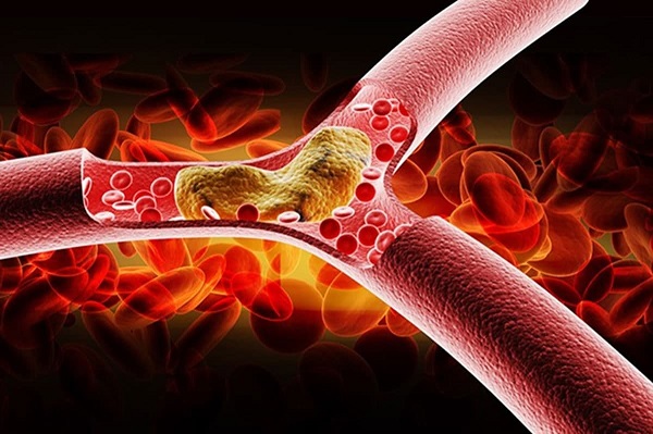 Thay đổi lối sống giúp kiểm soát nguy cơ mỡ máu