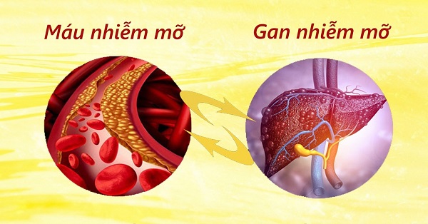 Ảnh mô tả sự nhầm lẫn giữa mỡ máu và gan nhiễm mỡ