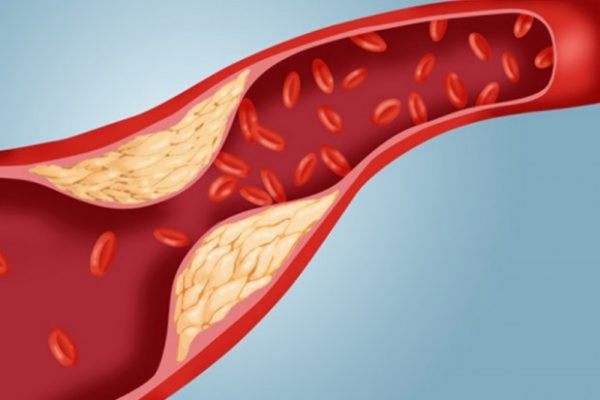 Mô tả ảnh: Hình ảnh minh họa về máu nhiễm mỡ và những nguy cơ tiềm ẩn
