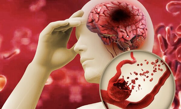 Mỡ máu cao là nguyên nhân tiềm ẩn dẫn tới đột quỵ