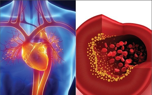Chuyên gia y tế khuyến cáo về kiểm soát mỡ máu và ngăn ngừa đột quỵ