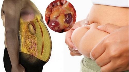 Mối liên hệ giữa mỡ máu và gan nhiễm mỡ