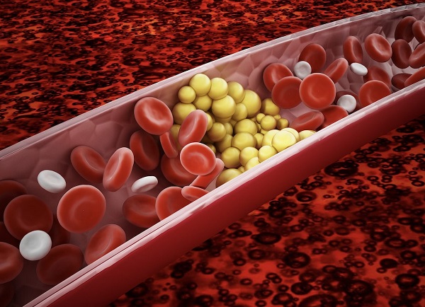 Hiểu đúng về các chỉ số mỡ trong máu và rối loạn lipid