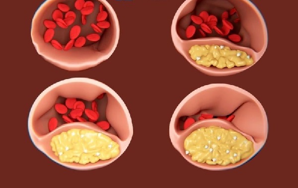 Nguy cơ và hậu quả mỡ máu cao, rối loạn lipid