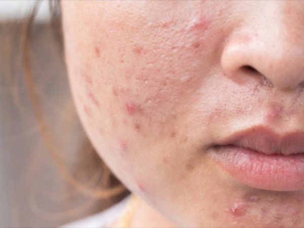 Mặt nổi mụn do nóng gan
