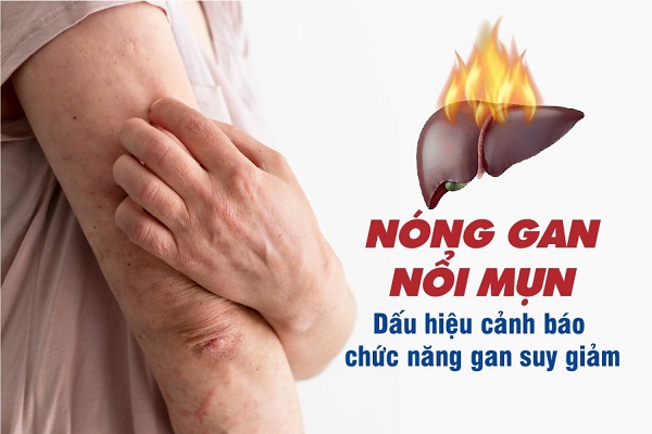 Thảo dược làm mát gan giảm mụn