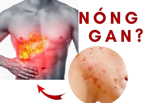 Nguy cơ khi tự ý dùng thảo dược trị mụn
