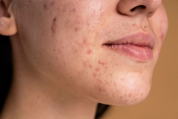 Gan: bộ máy giải độc của cơ thể, bị nóng gan dễ gây nổi mụn