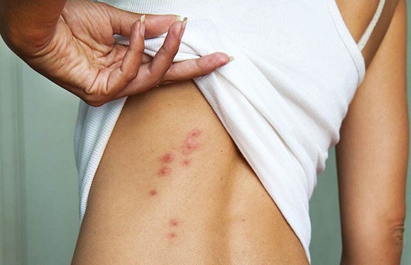 Sử dụng thảo dược thiên nhiên hỗ trợ giải độc gan, giảm mụn hiệu quả