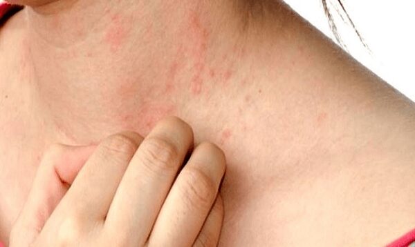 Nghiên cứu và câu chuyện thực tế về mụn do nóng gan