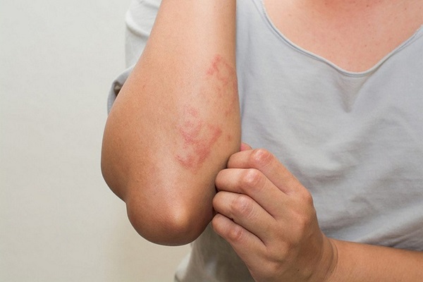 Sử dụng thảo dược mát gan giúp cải thiện làn da