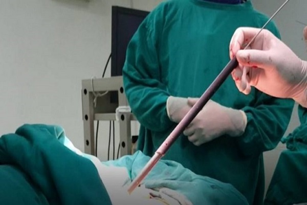 Mô phỏng kỹ thuật nội soi tán sỏi thận