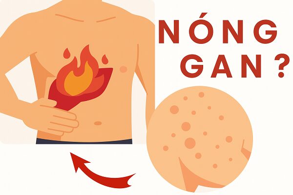 Cảnh báo tác hại khi tự ý điều trị nóng gan không đúng cách