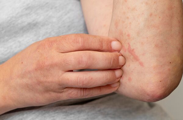 Dấu hiệu nóng gan dễ nhận biết