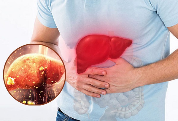 Hiểm họa từ nóng gan và cách nhận biết