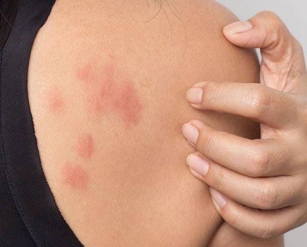 Dấu hiệu nhận biết nóng gan và nguy cơ tiềm ẩn cho sức khỏe