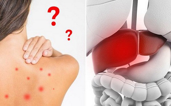 Tự điều trị nóng gan sai cách dễ dẫn đến biến chứng nguy hiểm