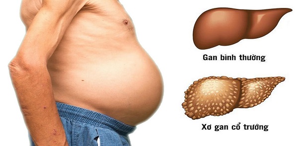 Hình ảnh miêu tả dấu hiệu nóng gan ở người trưởng thành
