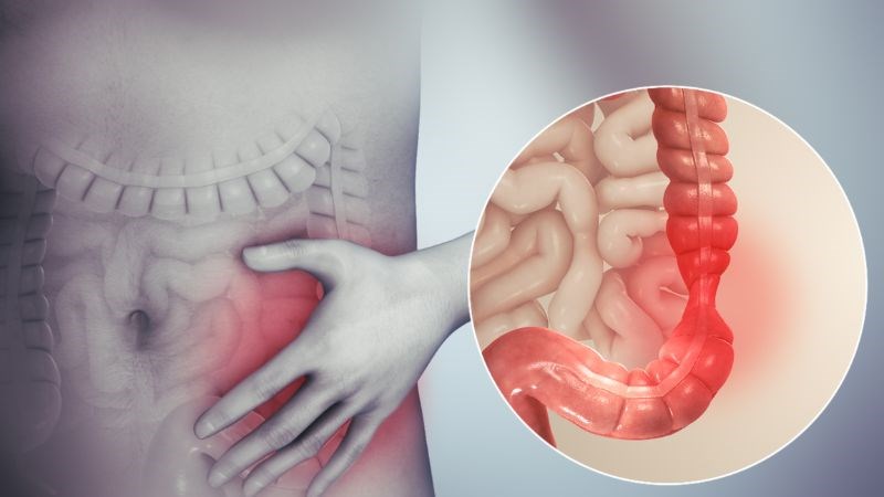 Nguyên nhân dẫn đến hội chứng ruột bị kích thích