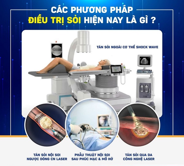 Các phương pháp điều trị sỏi thận thường gặp hiện nay