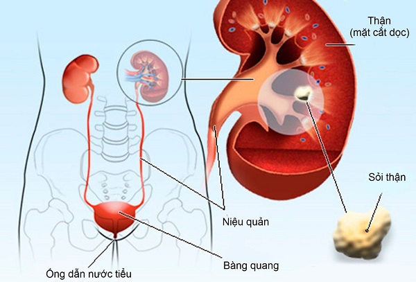 Cơ chế hình thành và yếu tố nguy cơ gây sỏi thận