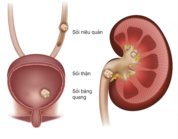 Biến chứng sỏi thận và cảnh báo khi điều trị không đúng cách
