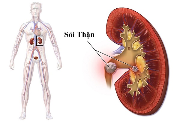 Giải pháp phòng ngừa và điều trị sỏi thận hiệu quả