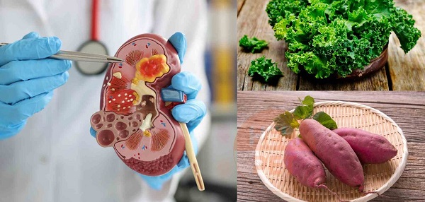 hình ảnh xây dựng thực đơn cho người sỏi thận
