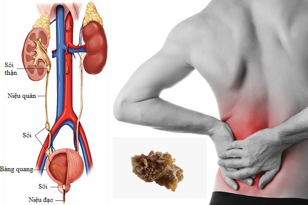 nguyên nhân gây sỏi thận