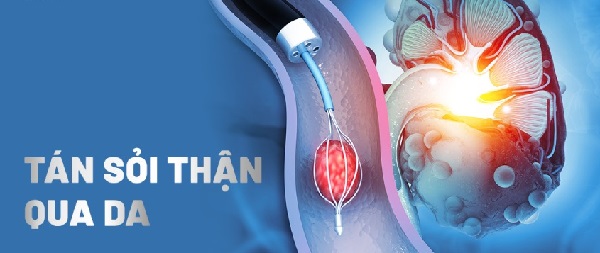 Cẩn trọng khi tự chữa sỏi thận không phẫu thuật – nguy cơ tiềm ẩn