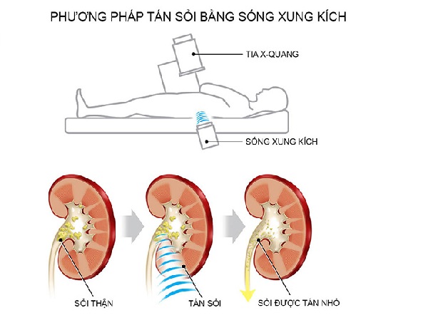 Kết hợp lối sống, chế độ ăn và thảo dược để phòng ngừa và điều trị sỏi thận