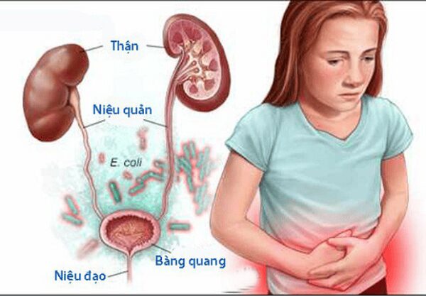 Trẻ em và người lớn đều có thể mắc sỏi thận