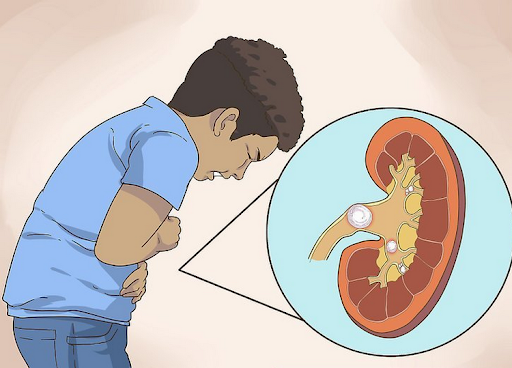 Sỏi thận ở trẻ em đang có xu hướng gia tăng