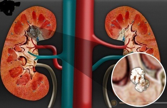 Tác hại của nội tạng động vật đối với người sỏi thận