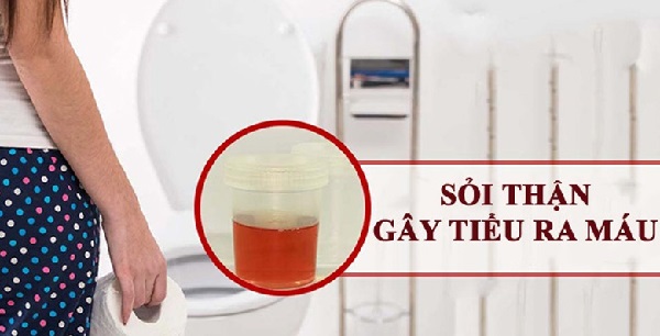 Hình ảnh sỏi thận và hiện tượng tiểu ra máu