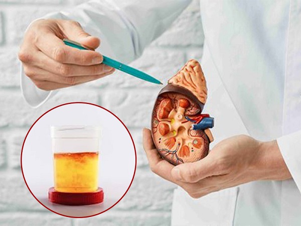 Sỏi thận di chuyển gây tổn thương niêm mạc đường tiết niệu