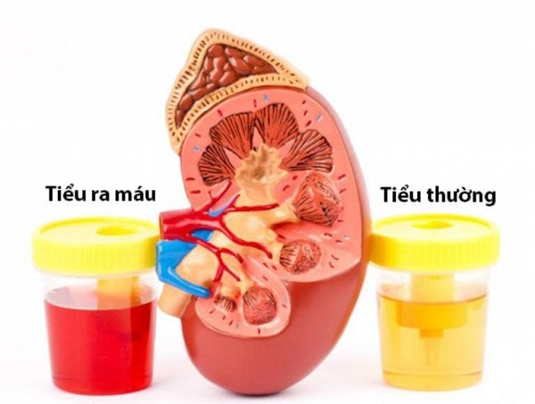 Cảnh báo về việc xác định nguyên nhân tiểu ra máu