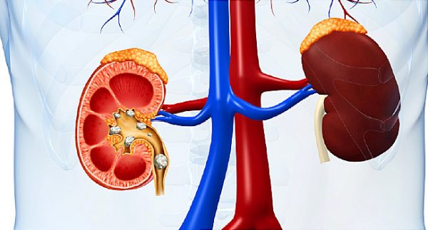 Sỏi thận có tự tan được không? Thực trạng và quan niệm phổ biến