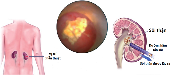 Hiểu đúng về các loại sỏi thận và cơ chế tự tan