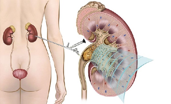 Ảnh minh họa: Sỏi thận và nỗi lo vô sinh