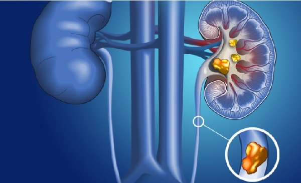 Ảnh cảnh báo: Sỏi thận không điều trị dễ gây biến chứng vô sinh