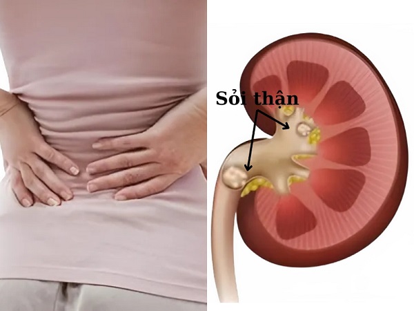 Các phương pháp tán sỏi thận hiện đại