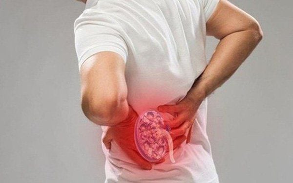 Nguy cơ tái phát sỏi thận cần lưu ý