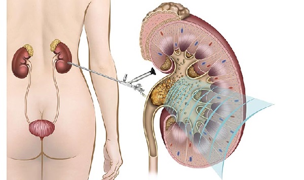 Giải pháp thực tế phòng ngừa sỏi thận tái phát
