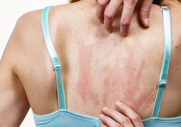 Mối liên hệ giữa tại sao nóng gan lại gây mụn lưng