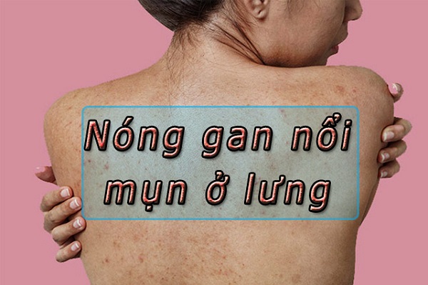 Thảo dược hỗ trợ gan giúp làn da giảm mụn lưng