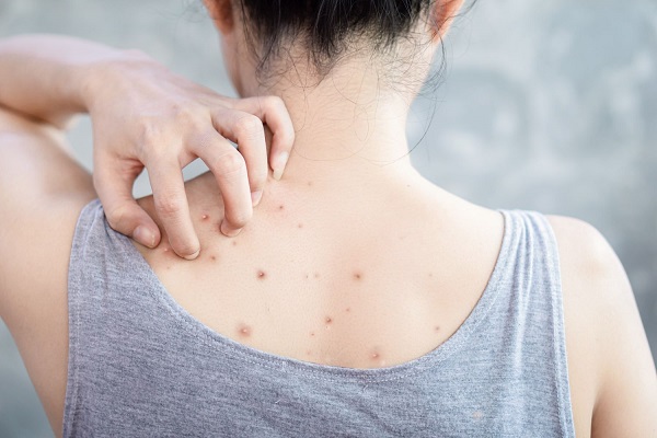 Rủi ro khi tự ý thải độc gan chữa mụn lưng